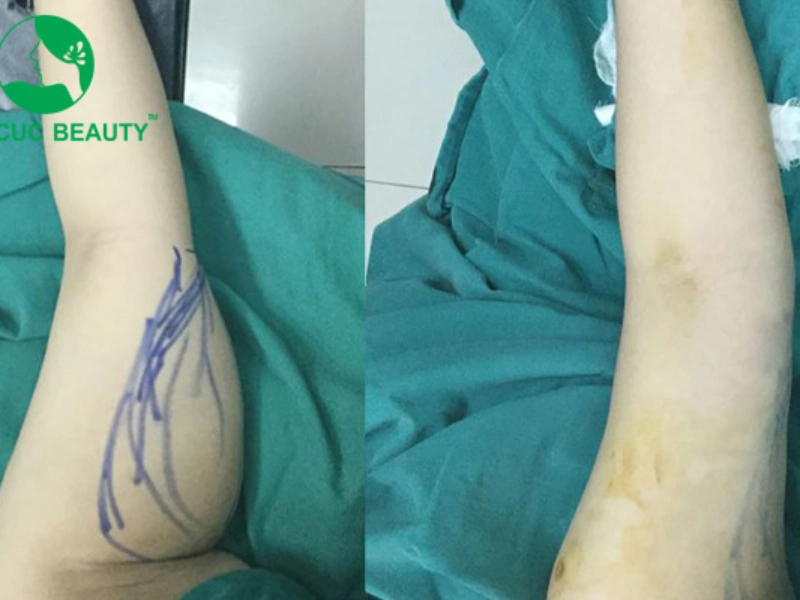 Dịch vụ hút mỡ bụng tại Bệnh viện thẩm mỹ Thu Cúc