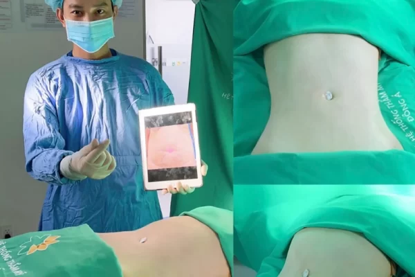 Thẩm mỹ viện Đông Á - Địa chỉ hút mỡ bụng uy tín tại Hà Nội