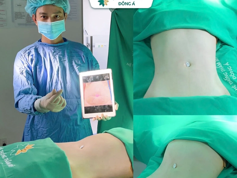 Thẩm mỹ viện Đông Á - Địa chỉ hút mỡ bụng uy tín tại Hà Nội