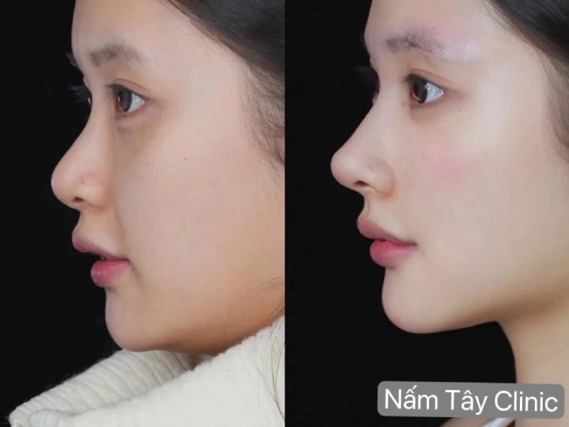 Nâng mũi tại Nấm Tây Clinic
