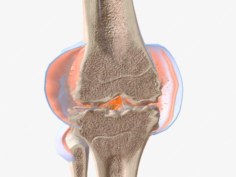 Loãng xương là hiện tượng mật độ và chất lượng xương giảm, khiến xương trở nên xốp và giòn hơn, dễ gãy.